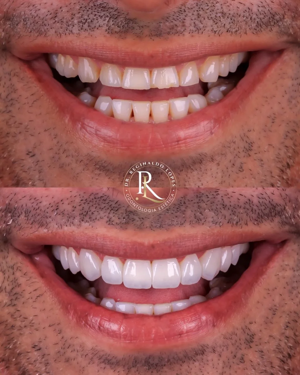 Resultado antes e depois — caso 05
