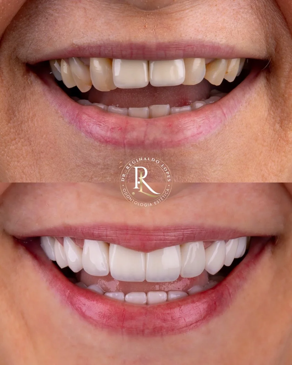 Resultado antes e depois — caso 06
