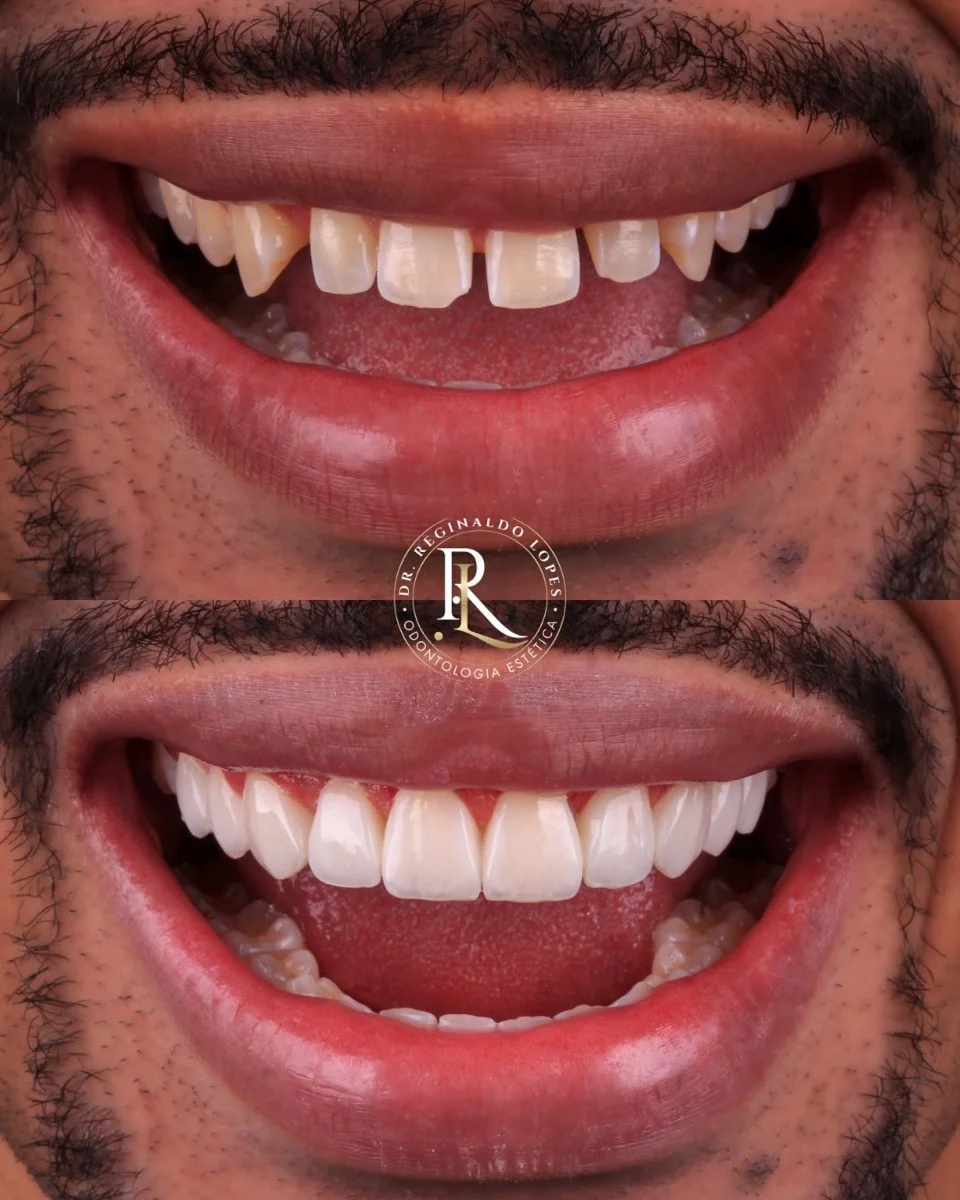 Resultado antes e depois — caso 11